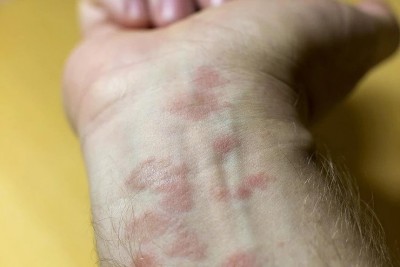 Can CBD Help with Eczema?